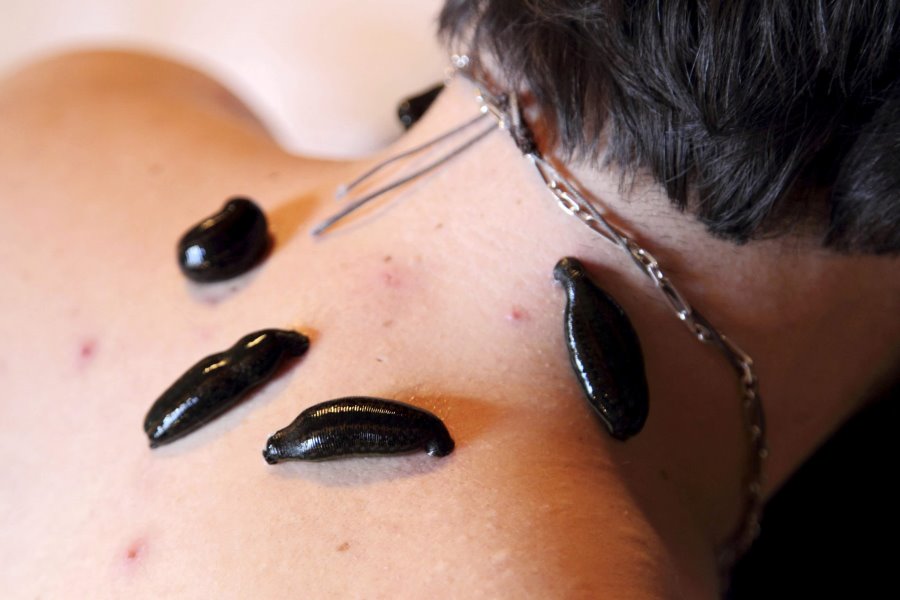 Raktamokshana in dermatological disorders
